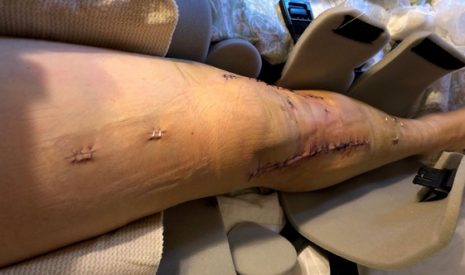 Photo 2 - McGee Lerer & Associates, Santa Monica, USA – 53-Year-Old Female E-scooter Rider Injury 05/9/18[2]. Photo shows leg with two long rows of stiches either side of knee with some staples and stiches below and above the knee. The leg is shown and is in a protective casing which is open on the front of the leg)